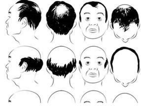 在南陽(yáng)，選擇種植頭發(fā)價(jià)格怎么說(shuō)？